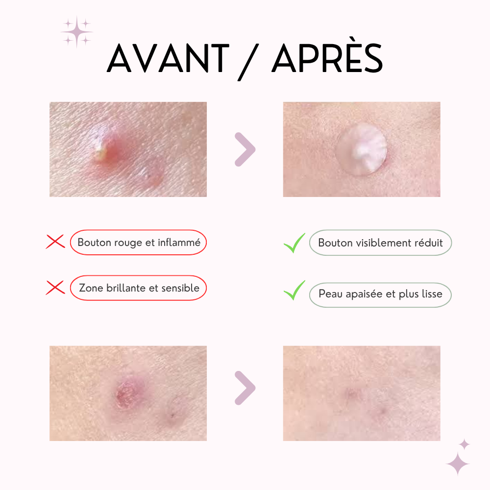 cosrx – patch boutons anti imperfections cosrx – patch boutons anti imperfections