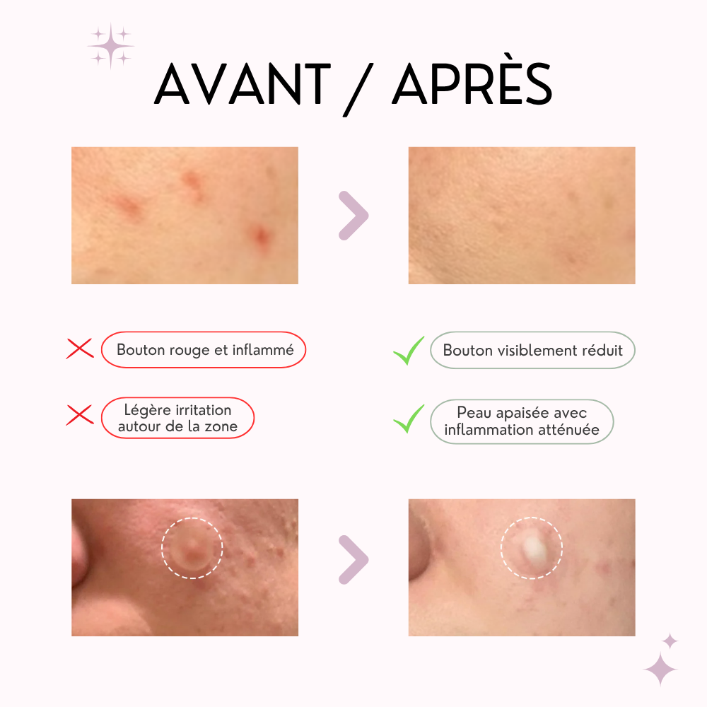 some by mi patch boutons, anti imperfections – 18 patchs some by mi patch boutons, anti imperfections – 18 patchs