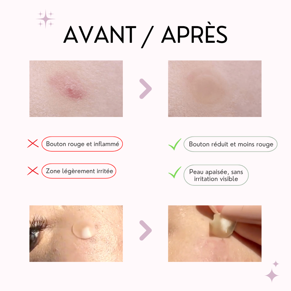 vt patch cica anti imperfections, anti acné vt patch cica anti imperfections, anti acné