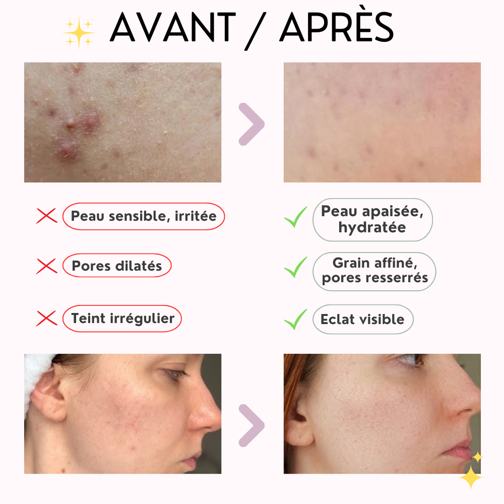 vt – reedle shot 100 vt – reedle shot 100